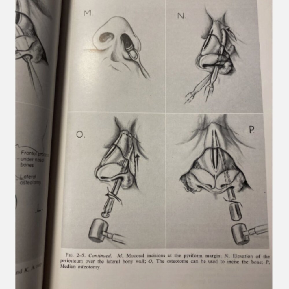 Diseases Of The Nose Throat And Ear 11th Ed John Jacob Ballenger - Picture 7 of 11